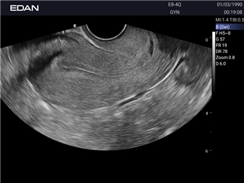 EDAN Acclarix LX25