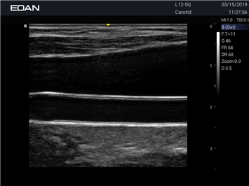 EDAN Acclarix LX3