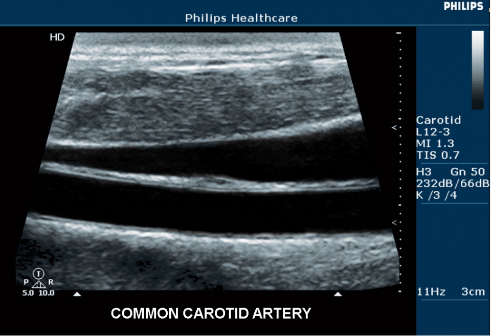 Philips HD5
